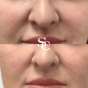 Nasolabial Fold Filler Before And After