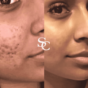 Scar Removal Treatment Before and After