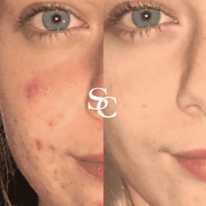 Scar Removal Treatment Result