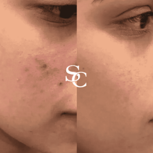 Scar Removal Treatment by Skin Club