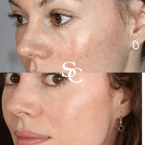 Skin Needling Treatment