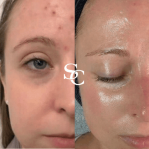 Skin Needling Before And After