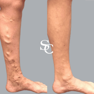 varicose veins Before and After