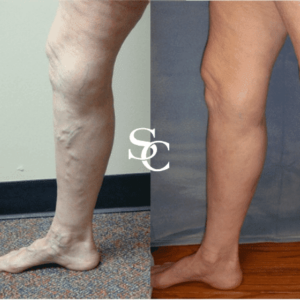 varicose veins Clinic in Melbourne