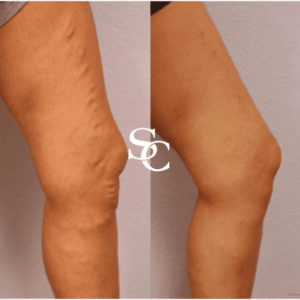 varicose veins Treatment in Melbourne