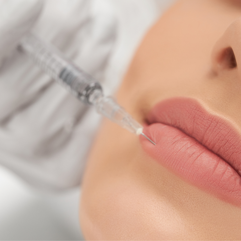 Lip Fillers in Melbourne By SkinClub Cosmetic Doctors