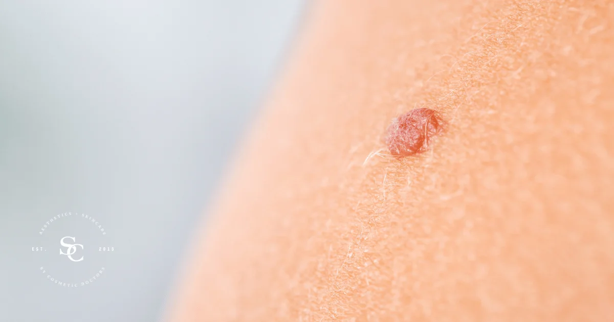 Angioma  Spot Check: skin cancer + aesthetics. Melbourne CBD